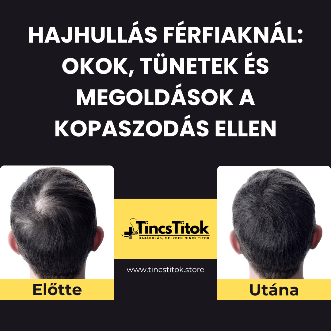 Hajhullás férfiaknál: okok, tünetek és megoldások a kopaszodás ellen - TincsTitok Webáruház