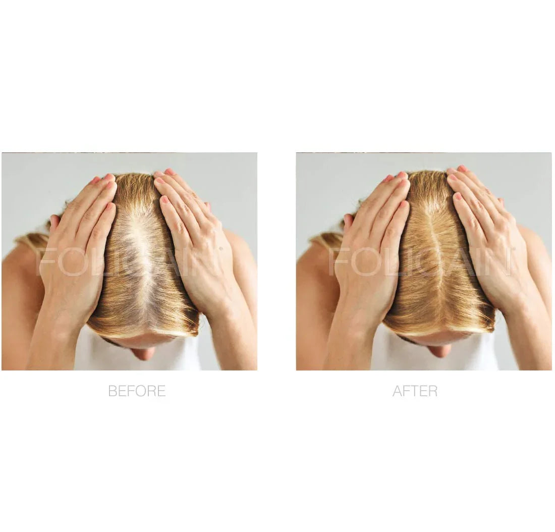 Sikertörténetek: Valódi tapasztalatok a Minoxidil és Trioxidil használatával - TincsTitok Webáruház