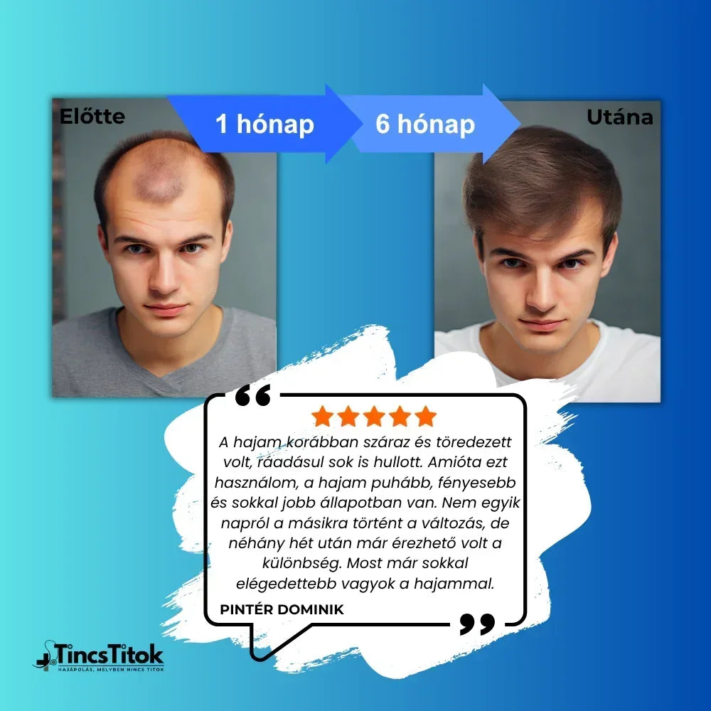 Kirkland® 5% Minoxidil Hab Férfiaknak - TincsTitok Webáruház