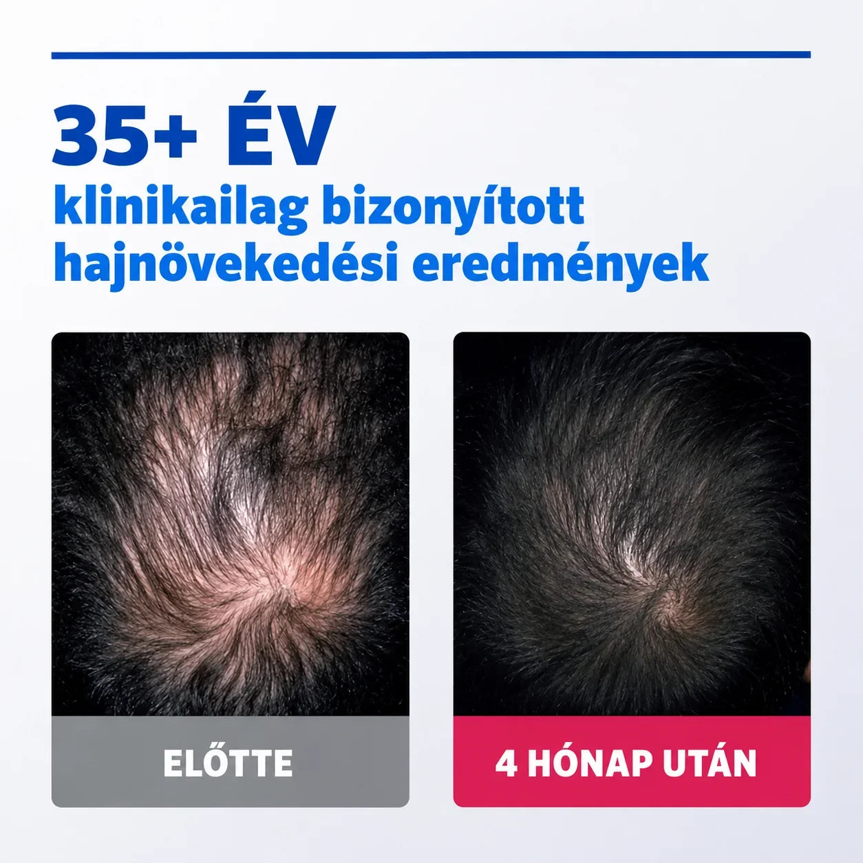 Rogaine® 5% Minoxidil Folyadék Férfiaknak - TincsTitok Webáruház
