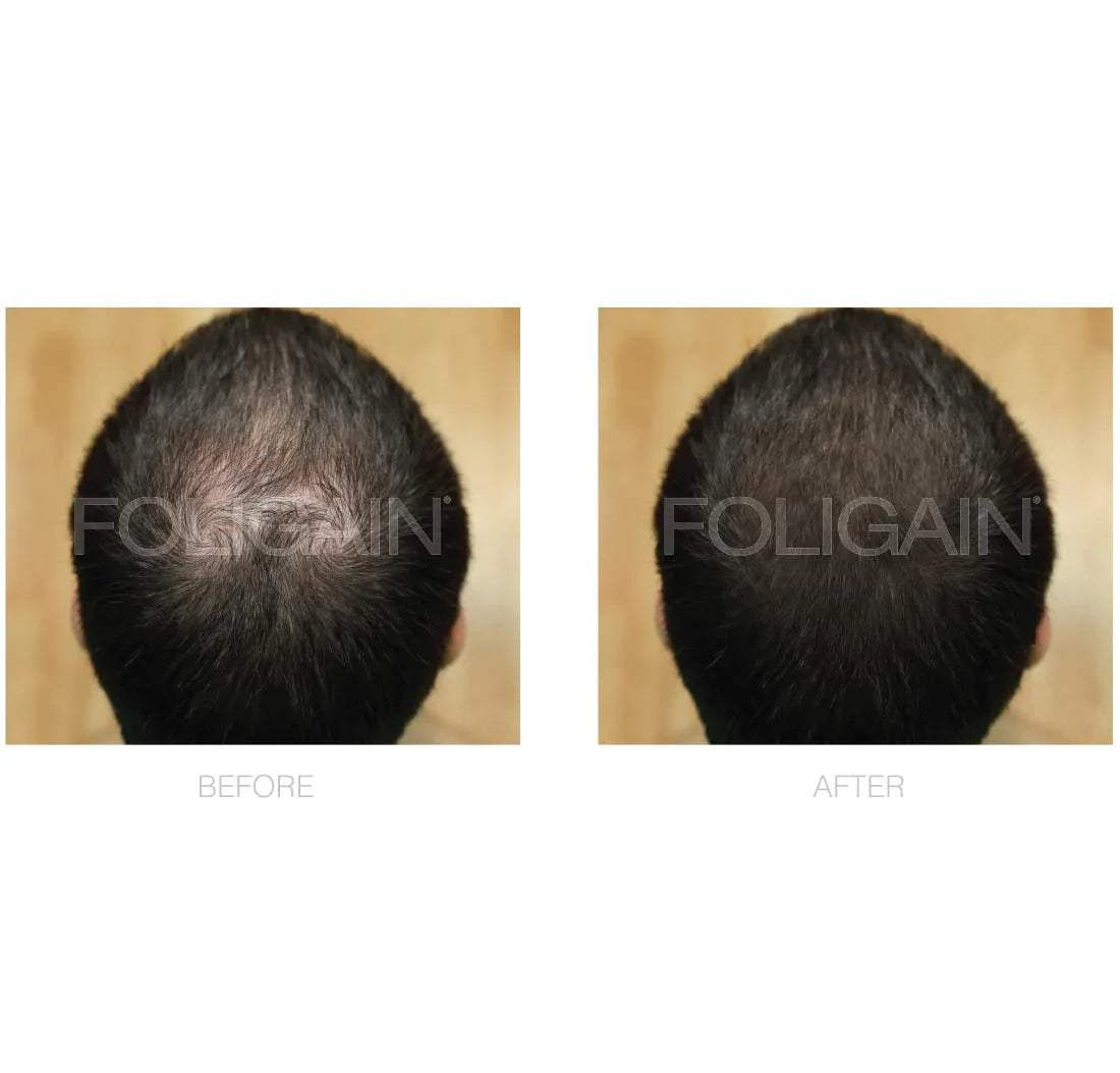 Men's Foligain® 5% Minoxidil Folyadék Férfiaknak (180 ml) - TincsTitok Webáruház
