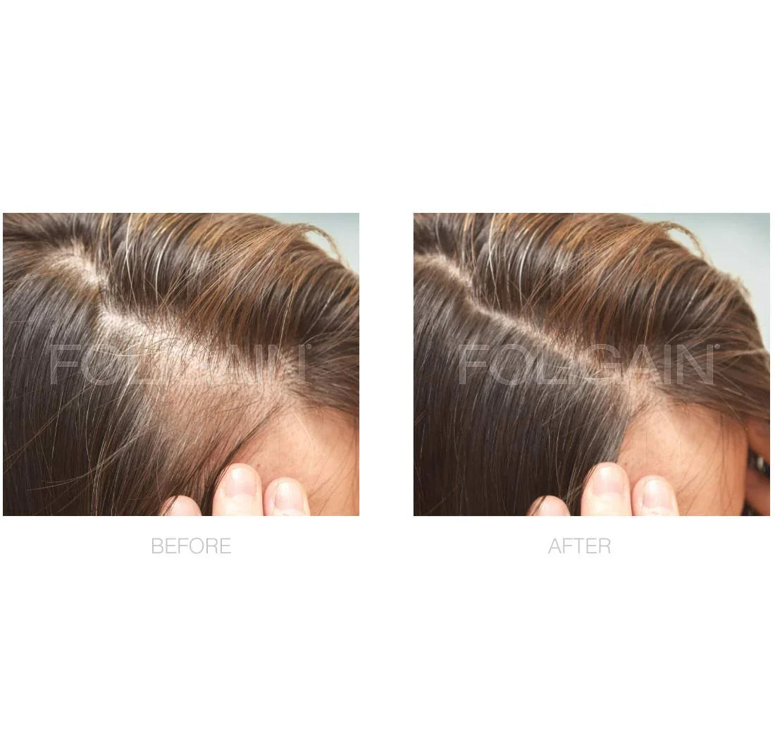 Women's Foligain® 2% Minoxidil Folyadék Nőknek (180 ml) - TincsTitok Webáruház